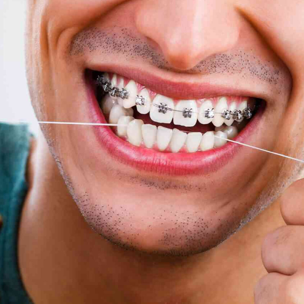 Braces