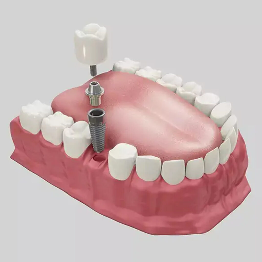 Dental-Implant