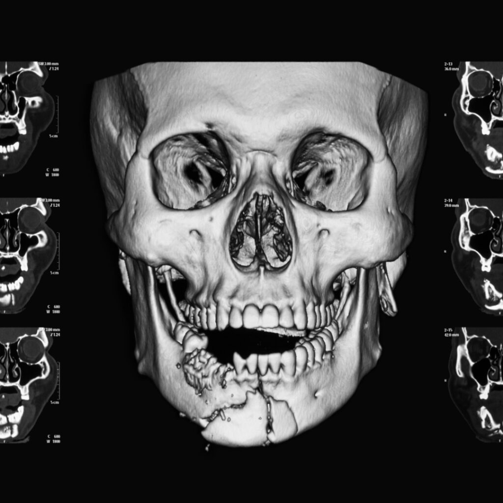 facial fractures